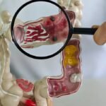 Doença intestinal passa de 30 para 158 casos por 100 mil