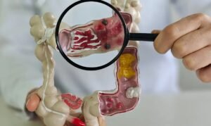 Doença intestinal passa de 30 para 158 casos por 100 mil